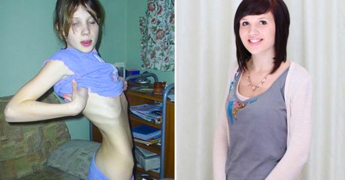 9 Inspiring photos of girls who overcame anorexia - matrix-studios.com